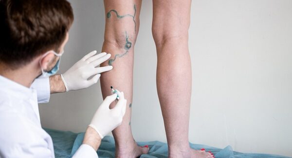 Cirujanos vasculares - Médico vascular evaluando a un paciente para el tratamiento de varices reconocido como uno de los mejores cirujanos vasculares en Sevilla