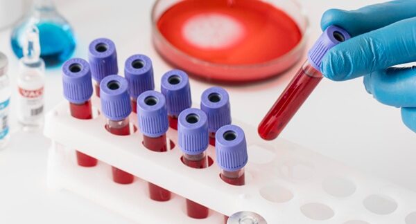 Departamentos de hematología - Hematólogo sosteniendo un tubo de ensayo clínico para diagnosticar enfermedad de la sangre en uno de los mejores departamentos de hematología de Sevilla