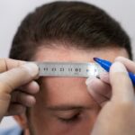 Tricólogos - Médico capilar reconocido como uno de los mejores tricólogos en Sevilla realizando el boceto del injerto de cabello a un hombre con alopecia en las entradas
