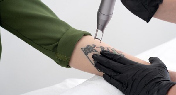 Centros de eliminación de tatuajes - Proceso para eliminar tatuajes láser en uno de los mejores centros de eliminación de tatuajes en Sevilla